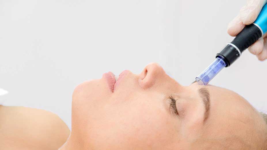 Woman microneedling derma needling on forehead before using neuro peptides BTX serum