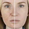 without sunscreen affects of sun damage skin microbiome